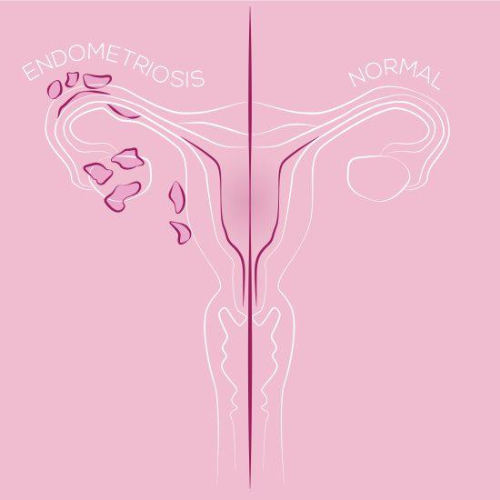 Illustration Of Endometriosis, Endometrial Tissue In The Uterus, Female Disease, Womens Medicine