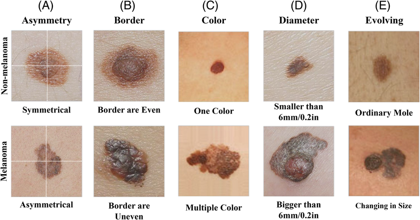 Illustration Of Abcde Criteria For Skin Cancer Detection